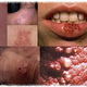Illustration for article titled Obat penyakit herpes untuk kelamin priaem/em